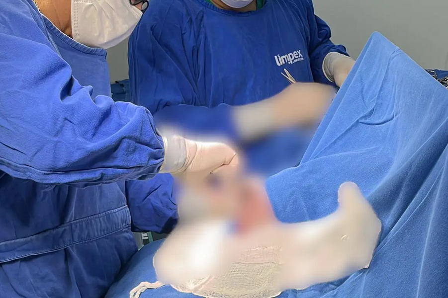 Hospital da Criança e do Adolescente realiza 1ª cirurgia para alívio de pressão intracraniana no novo centro cirúrgico