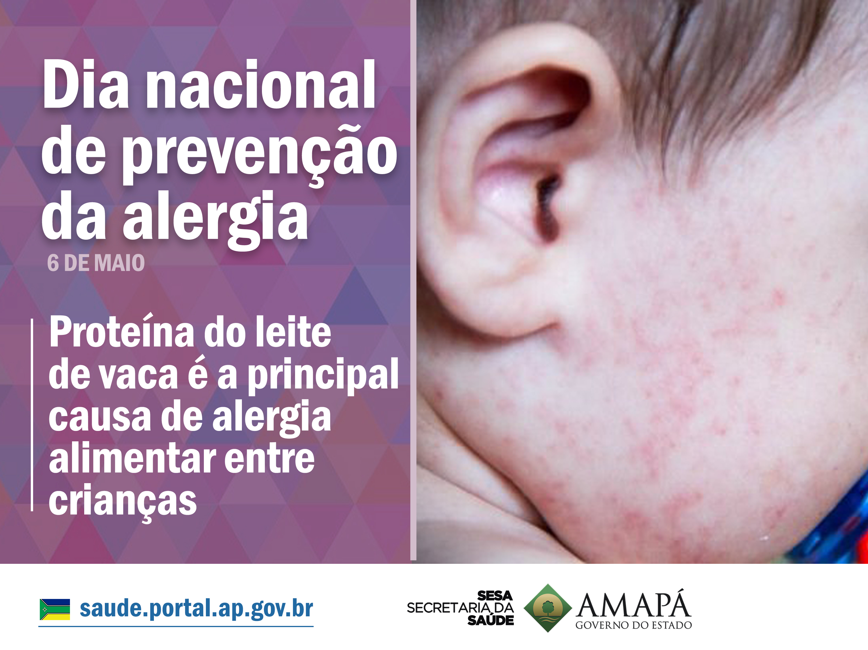 Proteína do leite de vaca é a principal causa de alergia alimentar entre as crianças