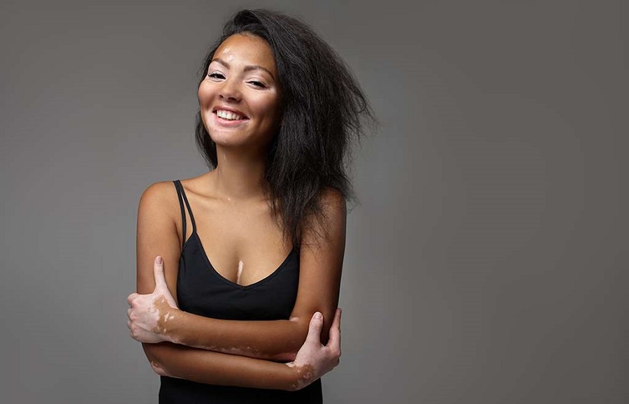 Vitiligo: tratamento realizado no CRDT trabalha a autoestima dos pacientes